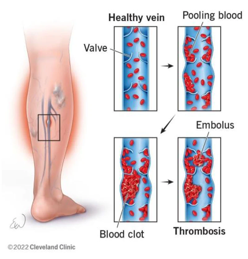 DVT treatment Wollongong Shoalhaven