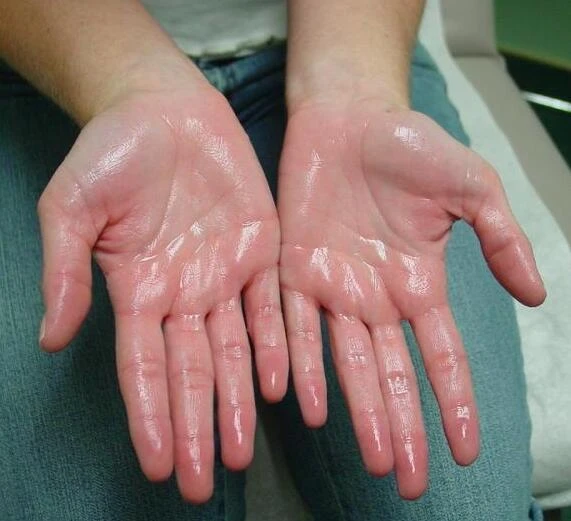 Photo of hand palms that are shining from excessive sweat